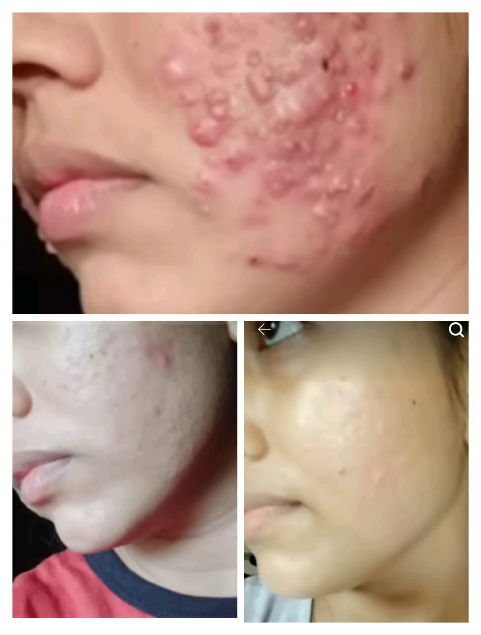 Acne Scars